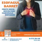 Esofagul Barrett