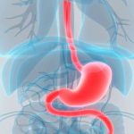 Acalazie esofagiana|acalazie cardia|Achalasia_Laparoscopic Myotomy