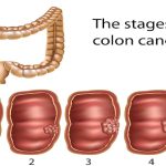 Cancer colon stadii