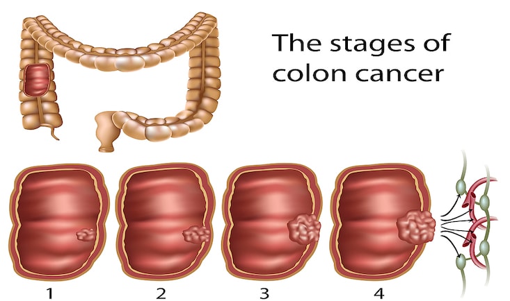 Cancer colon stadii