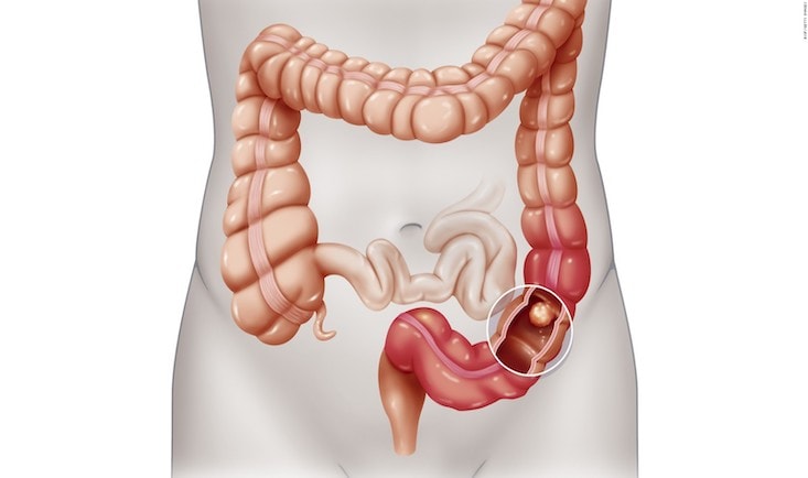 Cancerul de colon|Cancerul colorectal