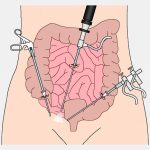 Chirurgie colorectala.