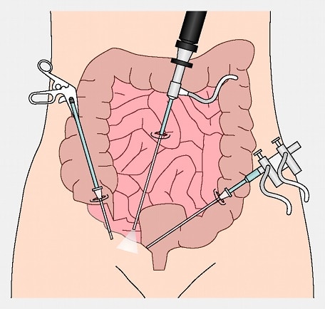 Chirurgie colorectala.