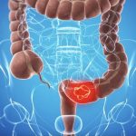 Cancer colon|colostomie