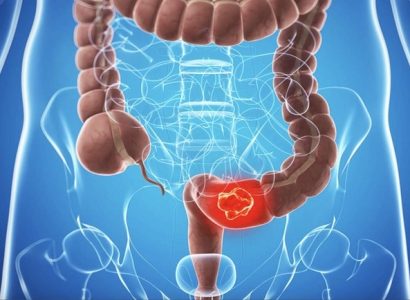 Cancer colon|colostomie