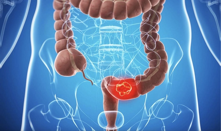 Cancer colon|colostomie