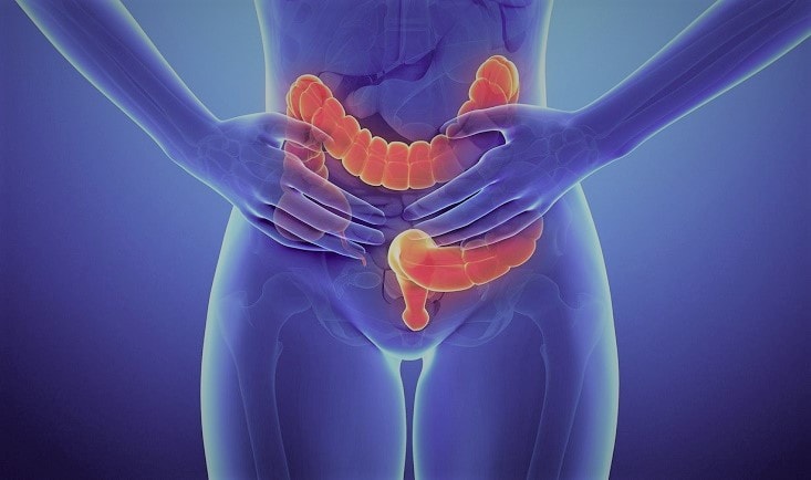 Cancerul rectal