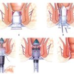 Hemoroidectomie minim invaziva