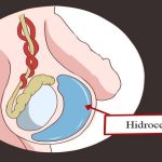 Hidrocel