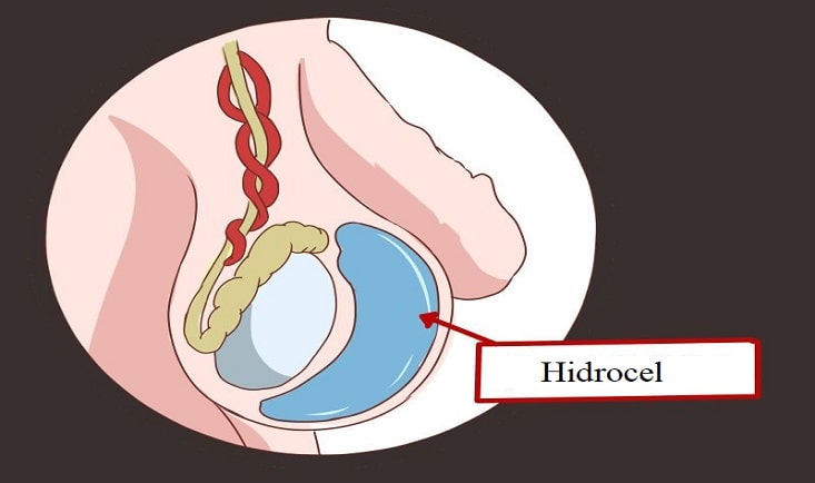 Hidrocel