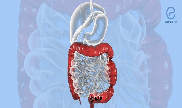 endo 4