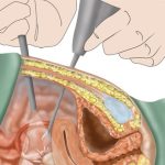 Laparoscopic-Hysterectomy