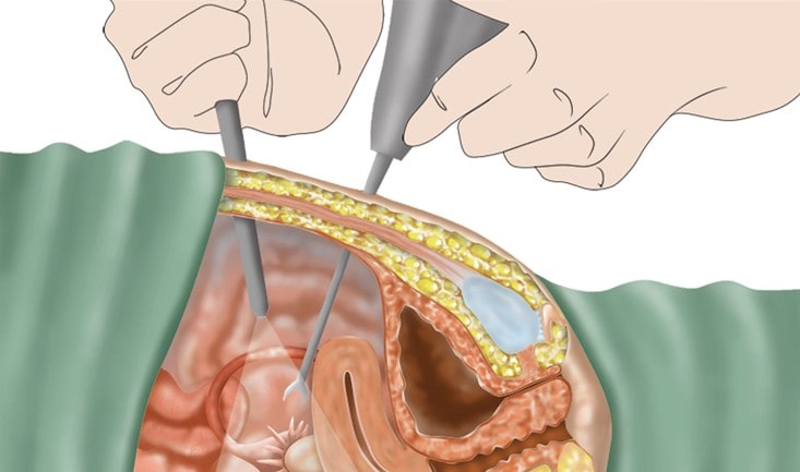 Laparoscopic-Hysterectomy