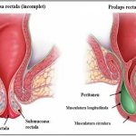 Prolaps rectal