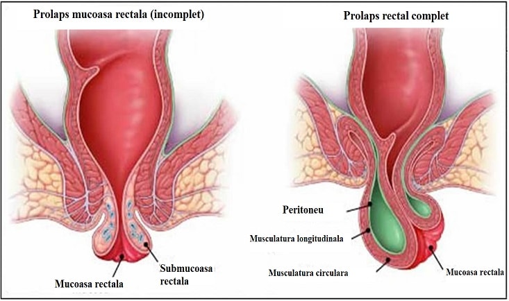Prolaps rectal