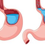 Reflux gastro-esofagian|hernie hiatala
