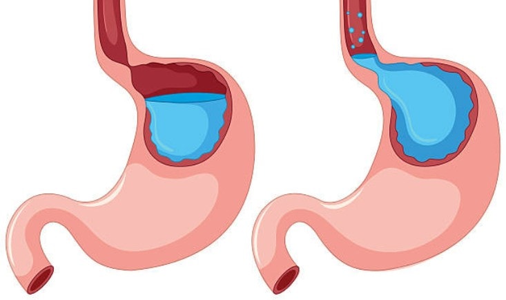 Reflux gastro-esofagian|hernie hiatala