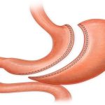 Sleeve_Gastrectomy|Gastrectomie