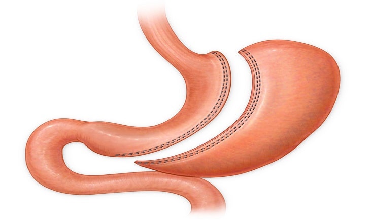 Sleeve_Gastrectomy|Gastrectomie