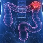 Tumora colon|cancer-colorectal