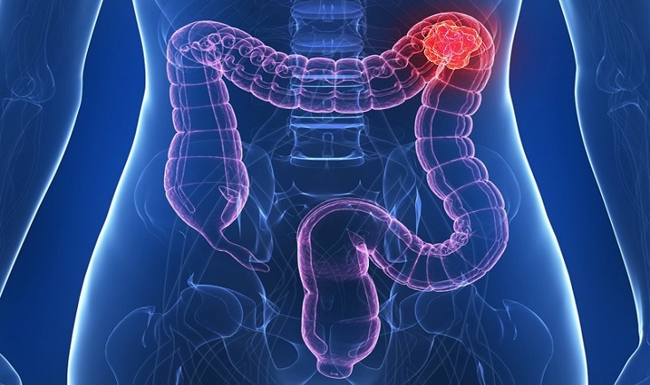 Tumora colon|cancer-colorectal