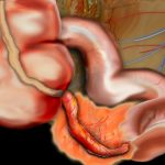 Tumora apendiculara|appendicitis-treatment