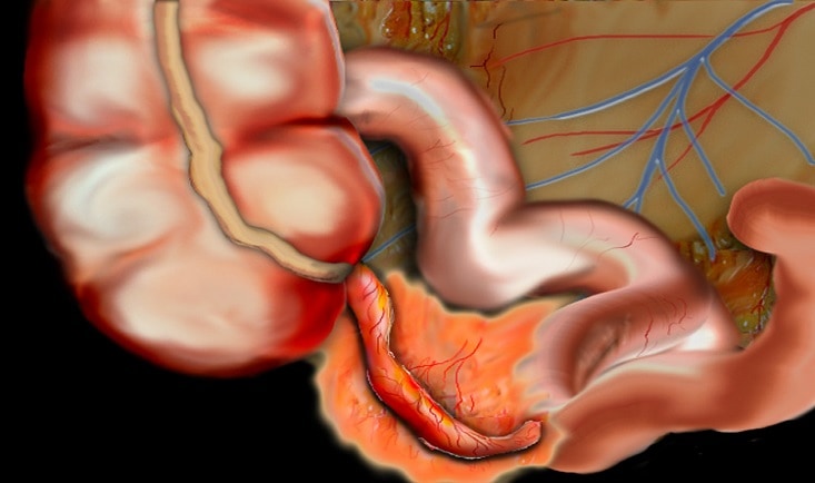 Tumora apendiculara|appendicitis-treatment