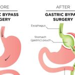 before-after-gastric_bypass