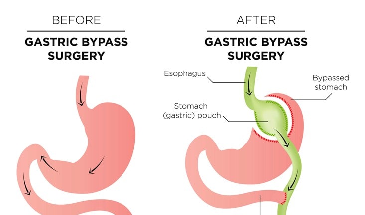 before-after-gastric_bypass