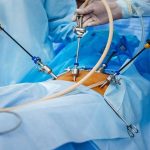 chirurgie laparoscopica