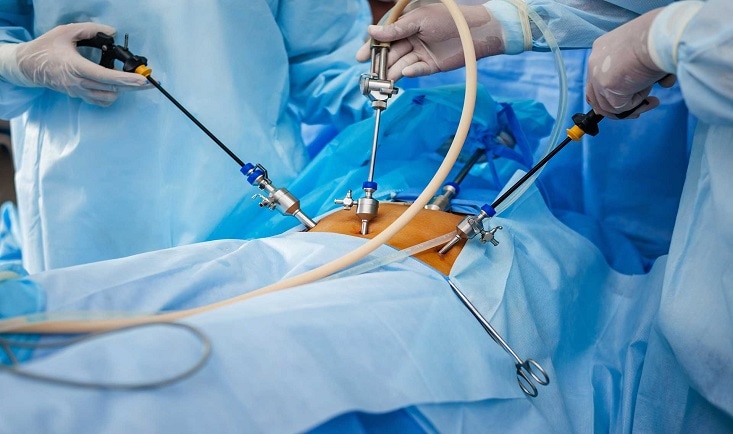 chirurgie laparoscopica