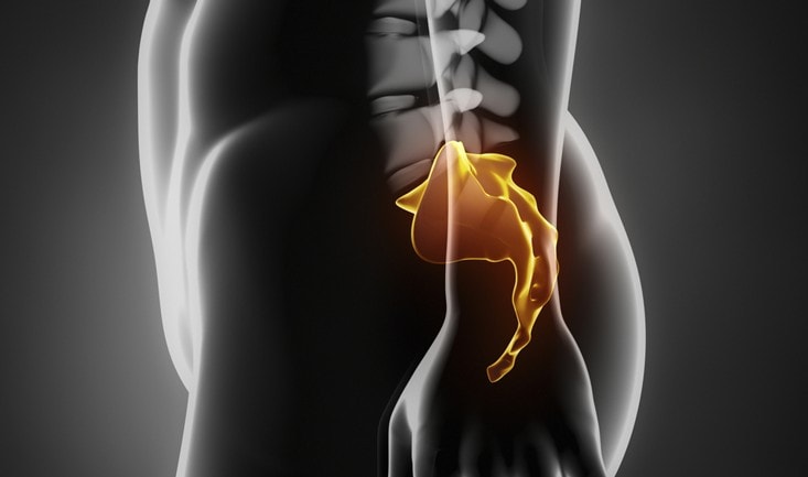 chist_pilonidal