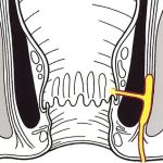 abcess-perianal