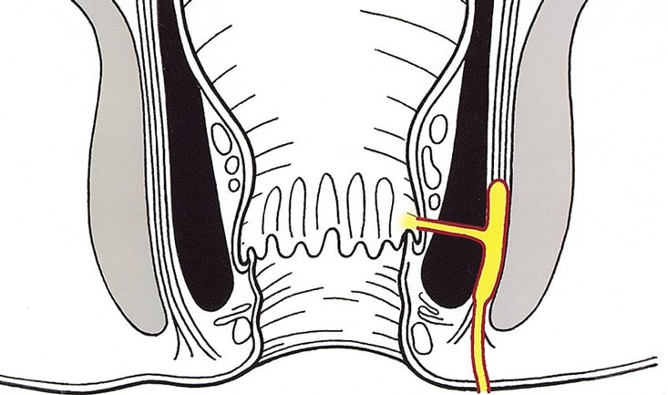 abcess-perianal