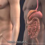 Hernie inghinala cu plasa|h inghinala
