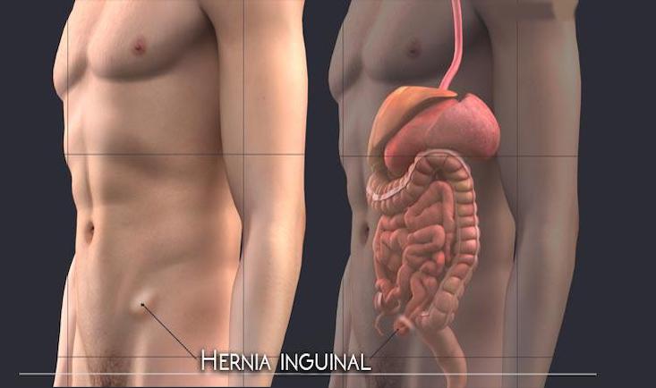 Hernie inghinala cu plasa|h inghinala