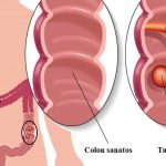 Cancer colon -operatie|polyps-in-colon|Cancer colon laparascopic|anastomosis-300x241