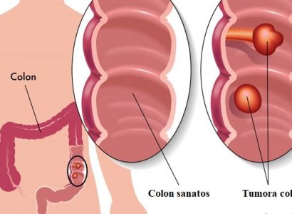 Cancer colon -operatie|polyps-in-colon|Cancer colon laparascopic|anastomosis-300x241