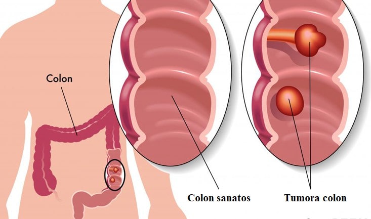 Cancer colon -operatie|polyps-in-colon|Cancer colon laparascopic|anastomosis-300x241