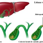 Hidropsul vezicular|