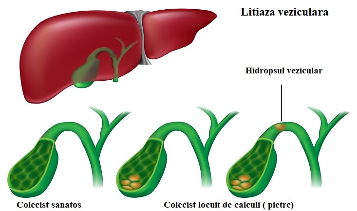 Hidropsul vezicular|